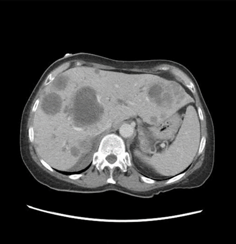 CT scan of abdomen confirming numerous mass lesions in the liver, radiologically compatible with diffuse metastatic disease.