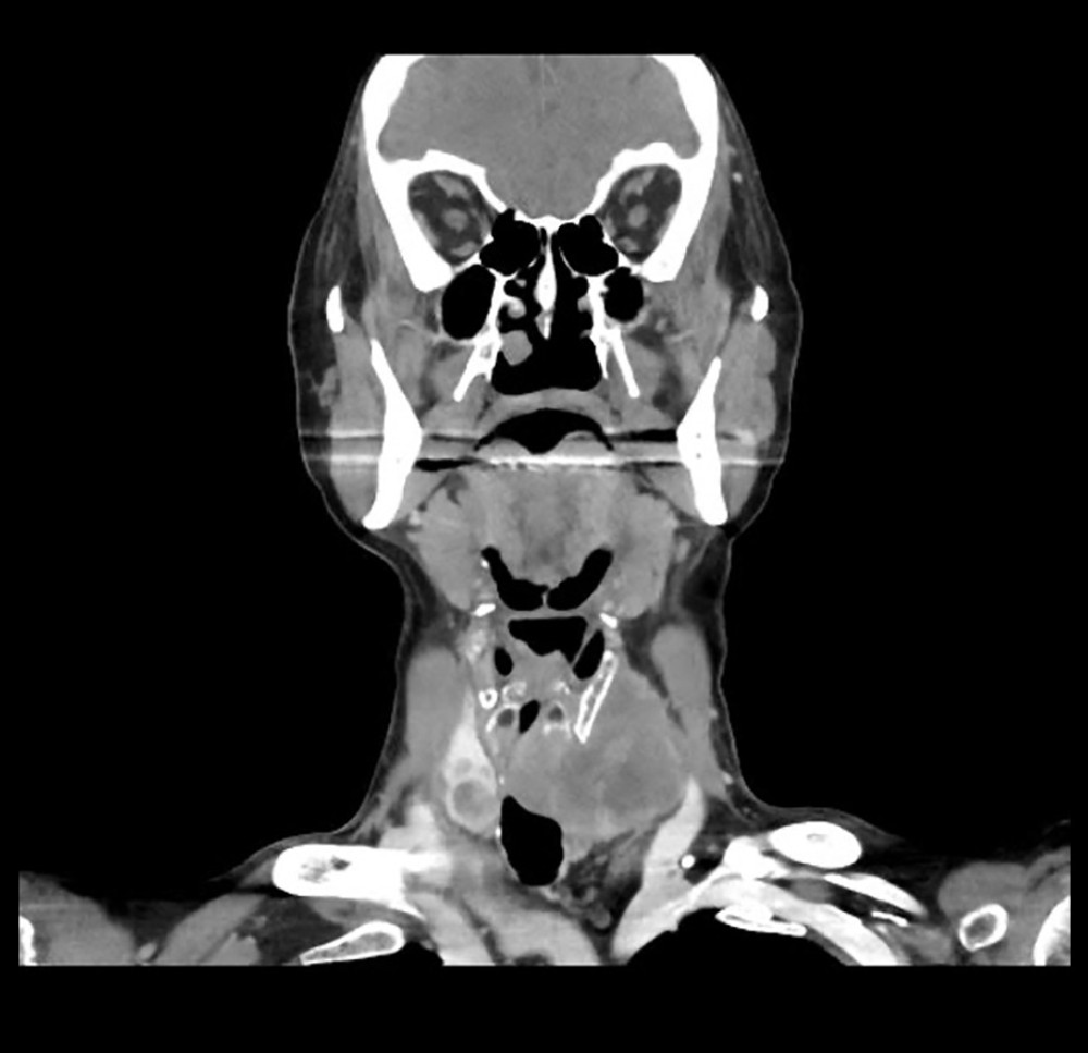 CT scan of neck confirming a large heterogenous mass involving the left thyroid lobe with surrounding soft tissue extension, associated stenosis of the trachea, and cervical lymph node involvement.