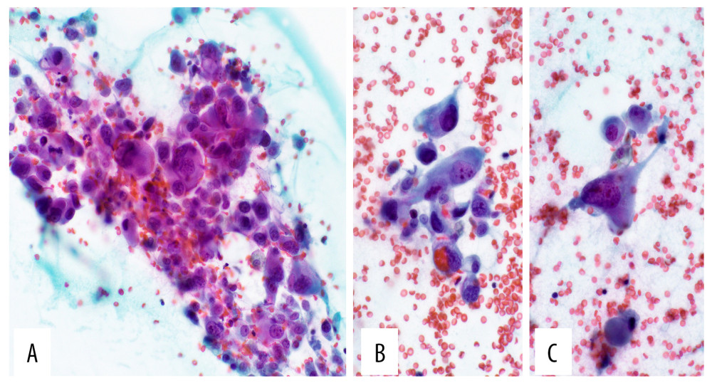 Cytomorphology from fine-needle aspiration of the liver specimen received with requisition stating a history of “jaundice and liver mass” without mention of disease elsewhere in the body. (A) Loosely cohesive population of overtly cytologically malignant cells with anisocytosis and varied morphologic features (Papanicolaou stain, 400×). (B) Some malignant cells with rounded-to-oval nuclei and open chromatin and others with spindled hyperchromatic nuclei (Papanicolaou stain, 600×). (C) Sarcomatoid cells with tapering cytoplasmic extensions, nuclear pleomorphism, and coarse chromatin readily identified (Papanicolaou stain, 600×).