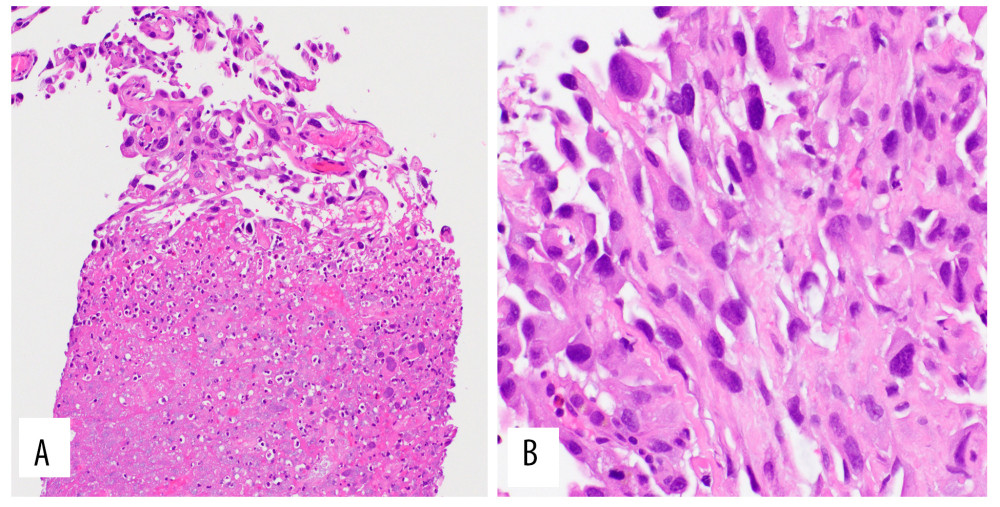 Histomorphology from liver core biopsy also received with requisition giving history of “jaundice and liver mass” without mention of disease elsewhere in body. (A) Geographic necrosis comprising much of the core biopsy with viable malignant cells at tips of cores (hematoxylin and eosin, 200×). (B) Pleomorphic malignant cells with predominantly spindled and focally epithelioid morphologies, nucleomegaly and hyperchromasia, compatible with a sarcomatoid morphology (hematoxylin and eosin, 400×).