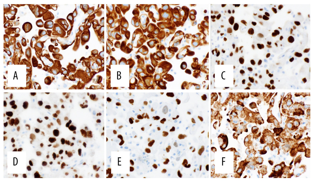 Immunohistochemistry from liver core biopsy. (A) Positive CK AE1/AE3 (600×). (B) Positive CK 7 (600×). (C) Positive PAX8 (600×). (D) Positive GATA3 (600×). (E) Positive TTF-1 (600×). (F) Positive BRAF V600E (600×).