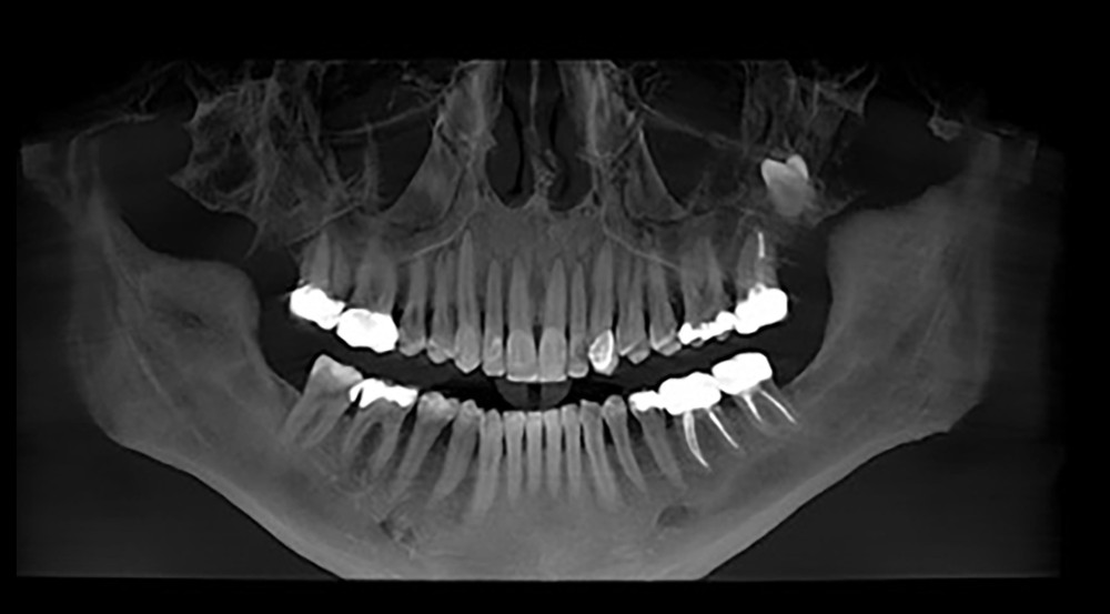 Orthopantomogram showing the inverted maxillary left third molar.