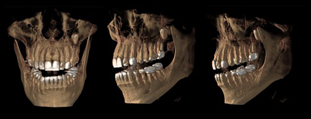 Cone-beam computed tomography showing the inverted maxillary left third molar.