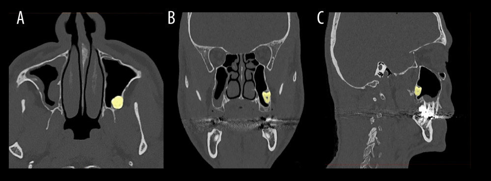 Volumetric computed tomography images of facial bones: (A) axial view, (B) coronal view, and (C) sagittal view, showing the location of the impacted tooth in relation to the maxillary sinus.