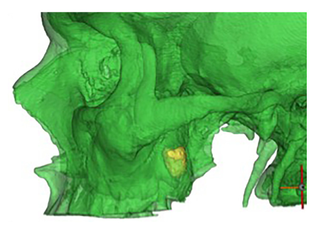 Volumetric computed tomography showing the location on the impacted tooth: the tooth is located in the posterior wall of the maxillary sinus, with part of the coronal portion perforating into the infratemporal fossa.