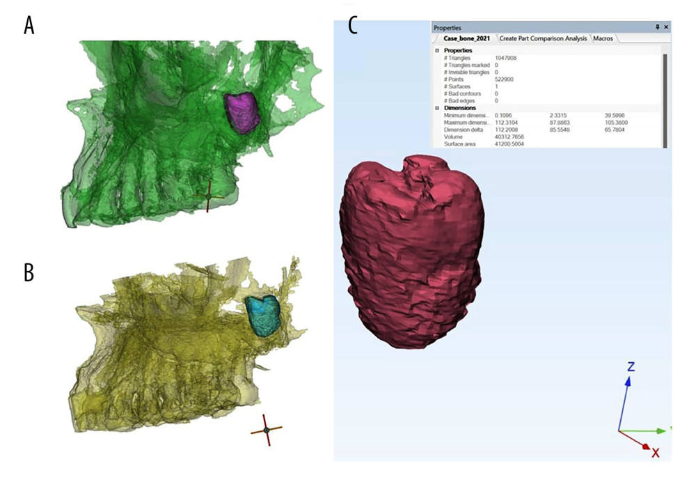 A 2-year follow-up scans for locational change. (A) Initial tooth location, (B) tooth location after 2 years, and (C) part comparison analysis showing complete superimposition of the 2 scans.