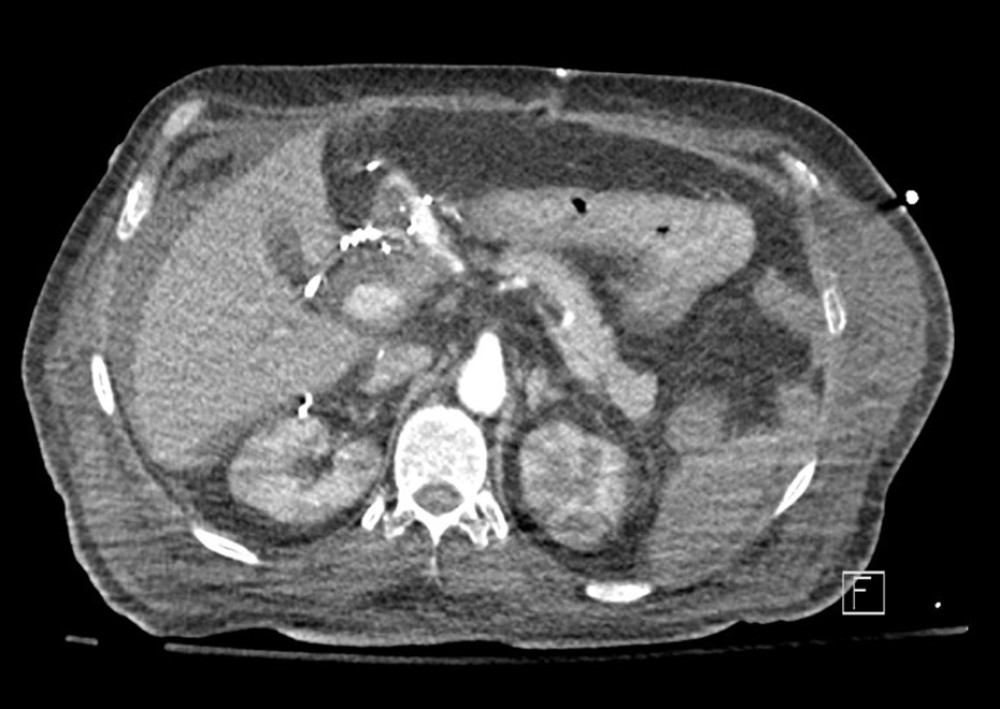 Narrowing of the hepatic artery anastomosis with post-anastomotic/stenotic dilatation of the distal artery. There is poor visualization of the hepatic artery distal to the dilatation, which may represent hepatic artery occlusion. Intrahepatic portions of the hepatic arteries are also not seen.