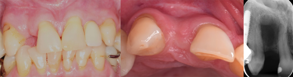 Intraoral photographs and a periapical radiograph, showing the missing maxillary lateral incisor space.