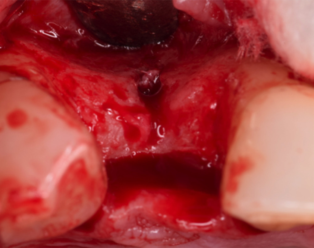 The bony fenestration detected at the area of tooth #12 upon reflecting the flap.