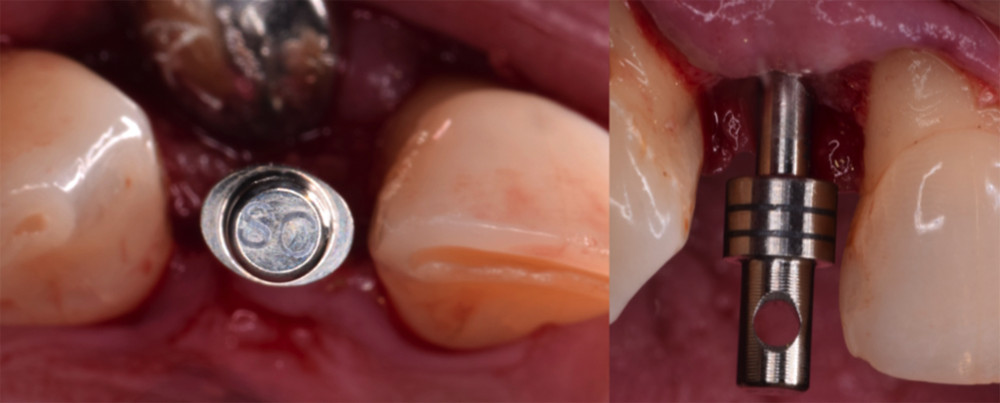 Position indicator placed in the implant bed to confirm positioning and angulation.