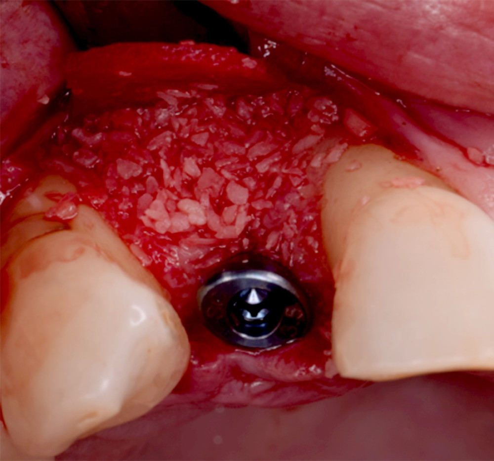 The intraosseous lesion filled with particulate bone graft, Straumann 2.9 mm Bone Level Tapered Implant placed, covered by healing abutment, with additional particulate bone graft added at the buccal side to be covered by resorbable collagen membrane.