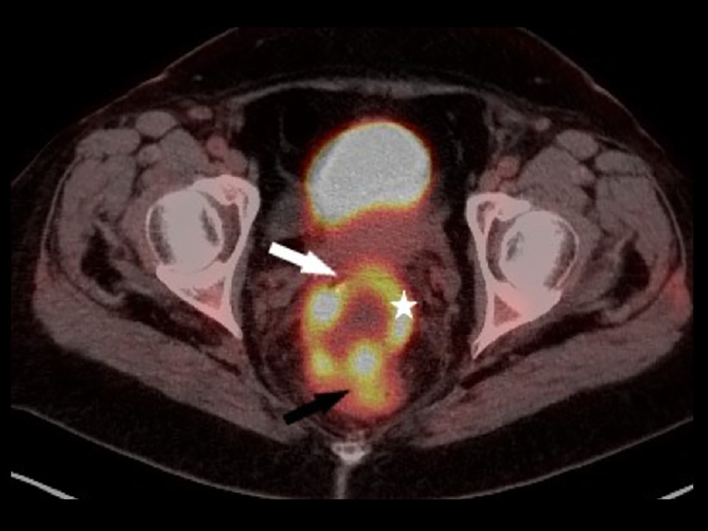 Axial FDG-PET scan demonstrating a large, markedly FDG avid mass involving the cervix (white arrow), rectum (black arrow), and a loop of adjacent sigmoid colon (star).