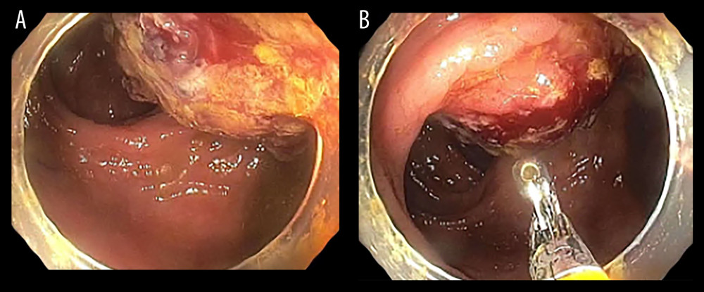 (A, B) Images from a colonoscopy demonstrating an oozing, fungating, and infiltrative non-obstructing mass 7 cm from the anus. The mass involved one-third of the luminal circumference.