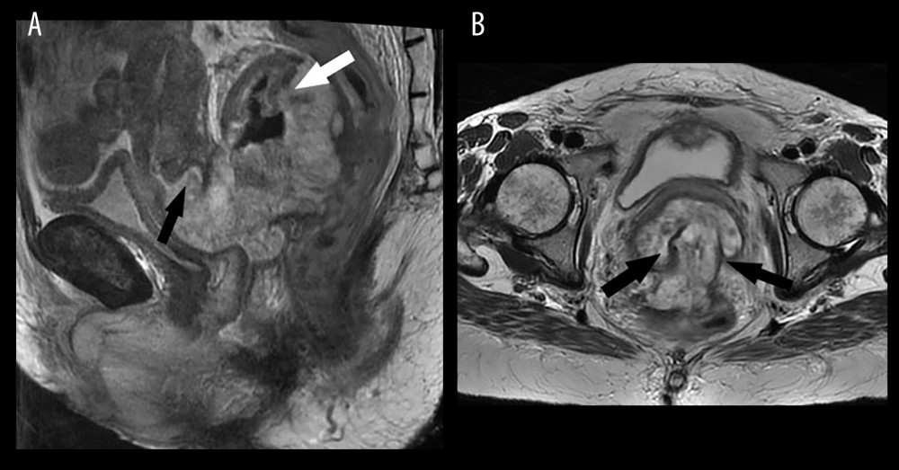 T2-weighted MRI sagital (A) and axial (B) images demonstrate a mucinous rectal carcinoma invading a loop of adjacent sigmoid colon (white arrow), the posterior vagina, and cervix (black arrow).