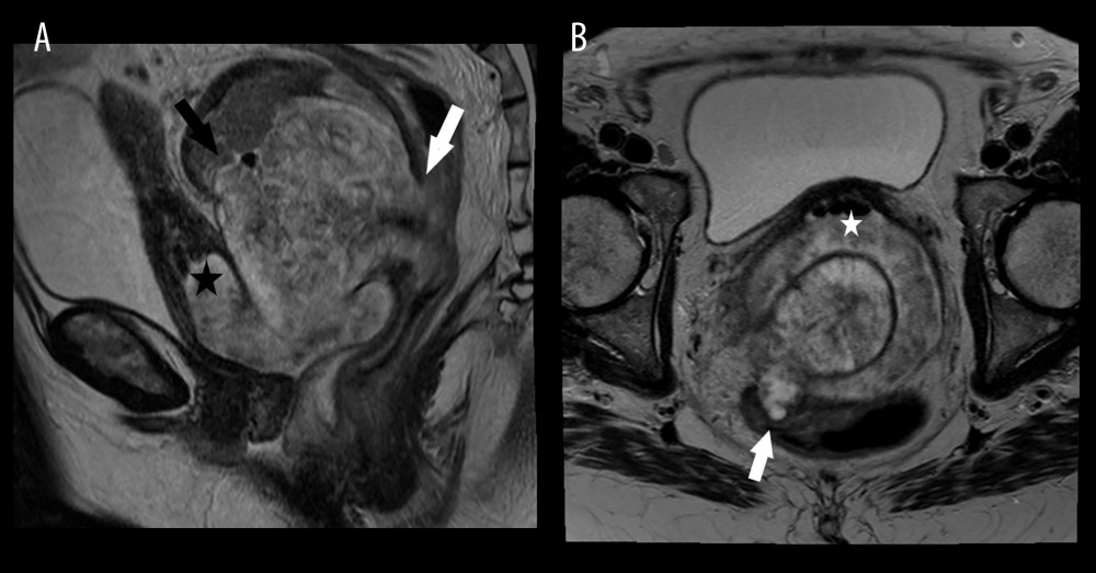 T2 weighted MRI sagital (A) and axial (B) images demonstrate progression of disease after modified FOLFOX-6 therapy. The rectum (white arrow), adjacent loop of sigmoid colon (black arrow), and cervix (star) are indicated.
