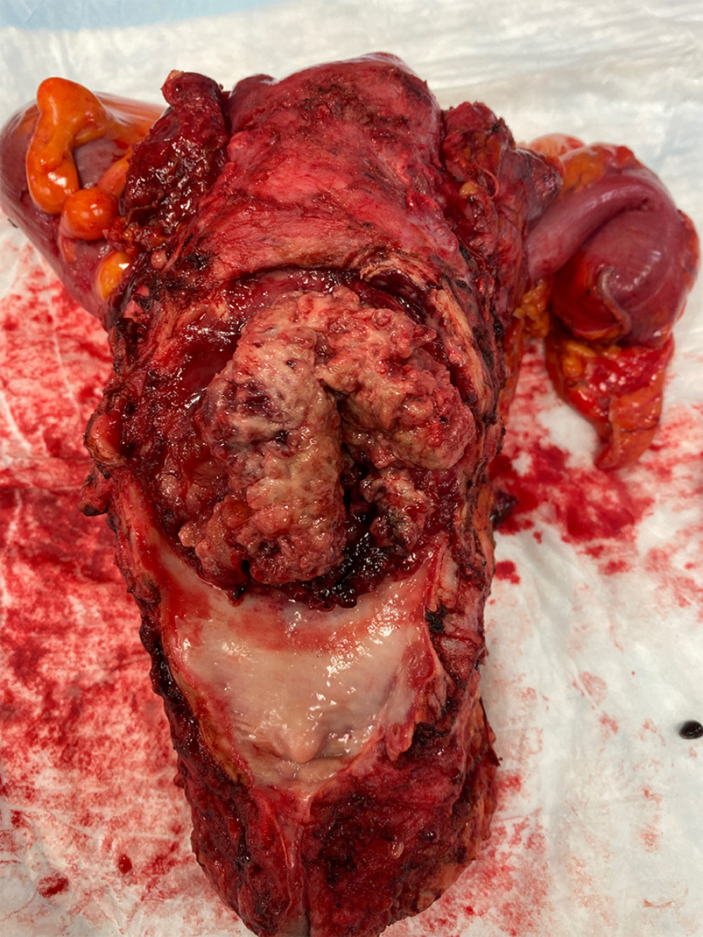 Photo of the resected surgical specimen showing a mass infiltrating from the rectum into the posterior vagina and cervix.