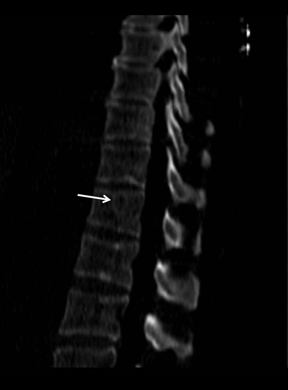 Computed tomography (CT) scan of the spine shows the osteolytic lesion (arrow) of T12.