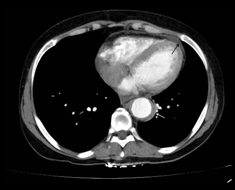 Computed tomography (CT) scan with contrast of the chest shows a mild pericardial effusion (black arrow) and coated aortic sign (white arrow).