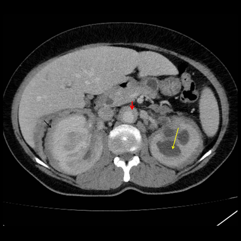 Computed tomography (CT) scan of the abdomen shows hydronephrosis in the left kidney (yellow arrow) and enlarged right kidney with perinephric fatty infiltration “hairy kidney sign” (black arrow) and periaortic fatty infiltration “coated aorta sign” (red arrow).