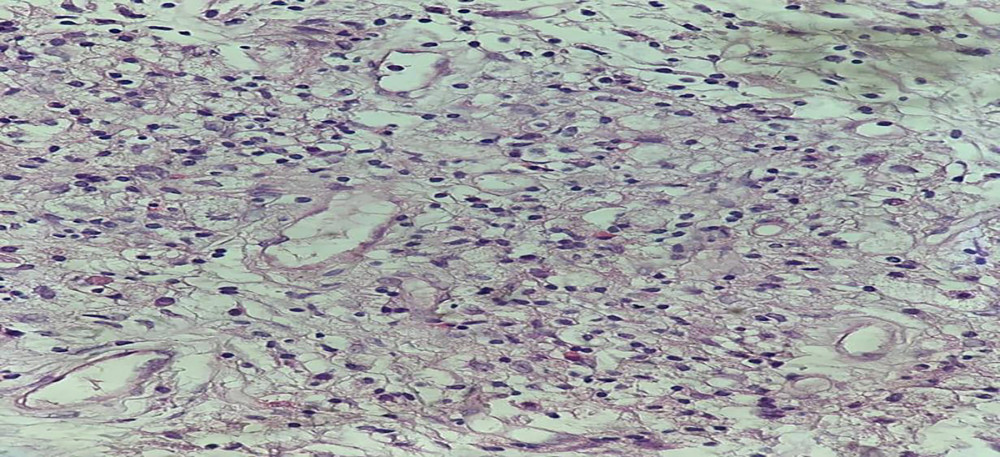 Histological sample of a kidney biopsy stained with hematoxylin and eosin: Foamy histiocytes admixed with scattered lymphocytes.