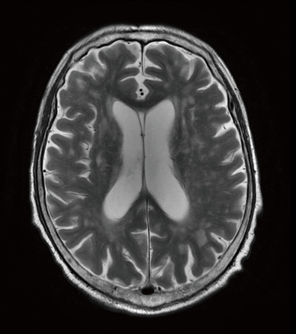 Brain T2-weighted MRI shows increased signal intensity in the bilateral periventricular and subcortical white matter.