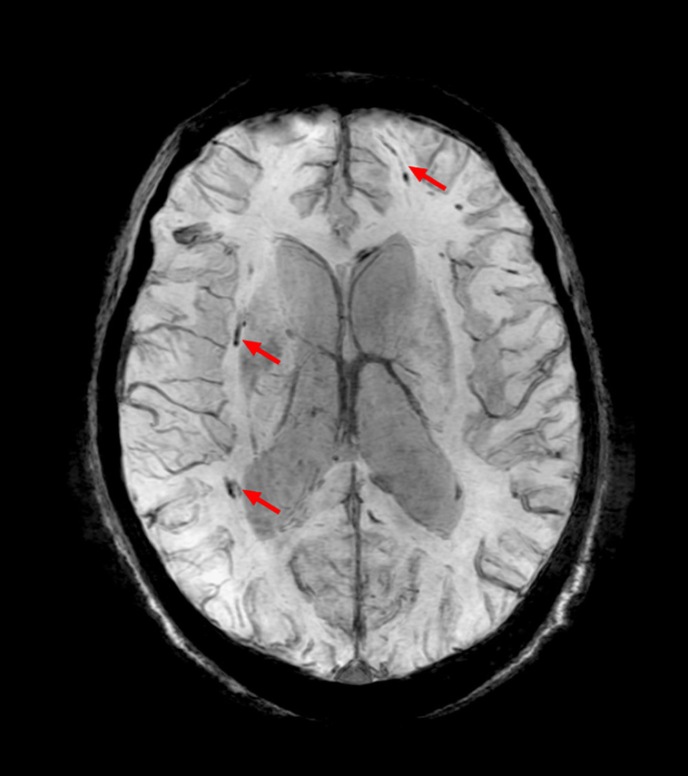 Brain SWI MRI showed linear hypointensities (arrows) over bilateral cerebral hemispheres.