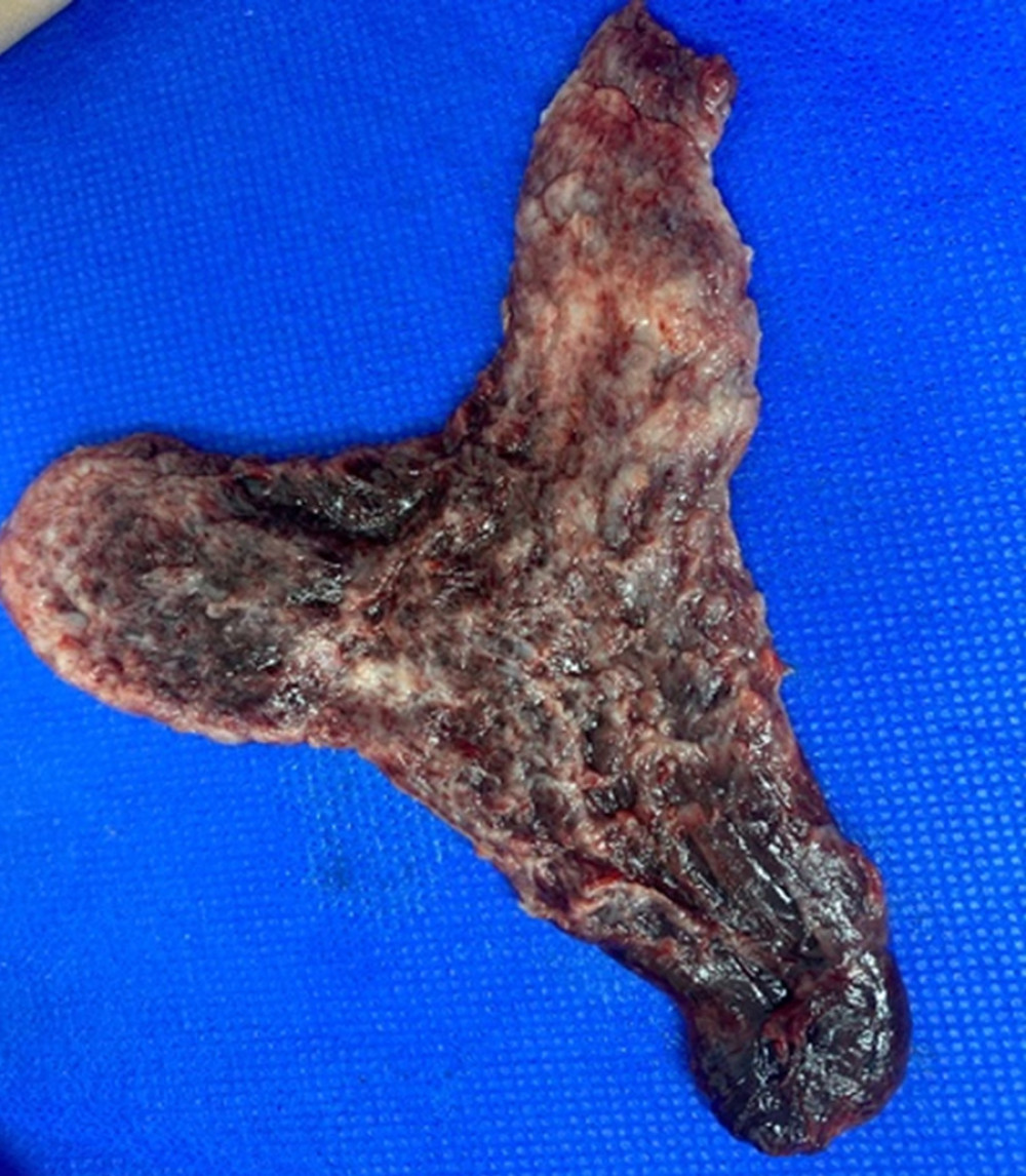 Complete and intact endometrial form with the appearance of an endometrial cavity.