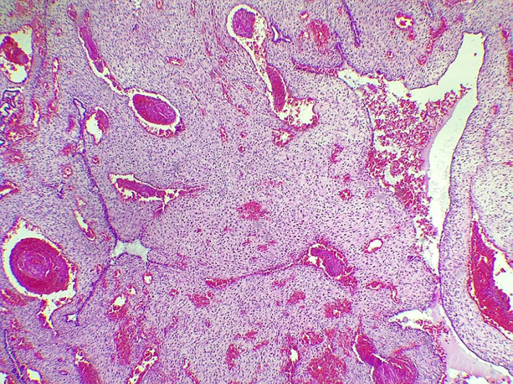 Photomicrograph of pre-decidualized endometrium with dilated and congested vessels. Hematoxylin and eosin staining, 4×.