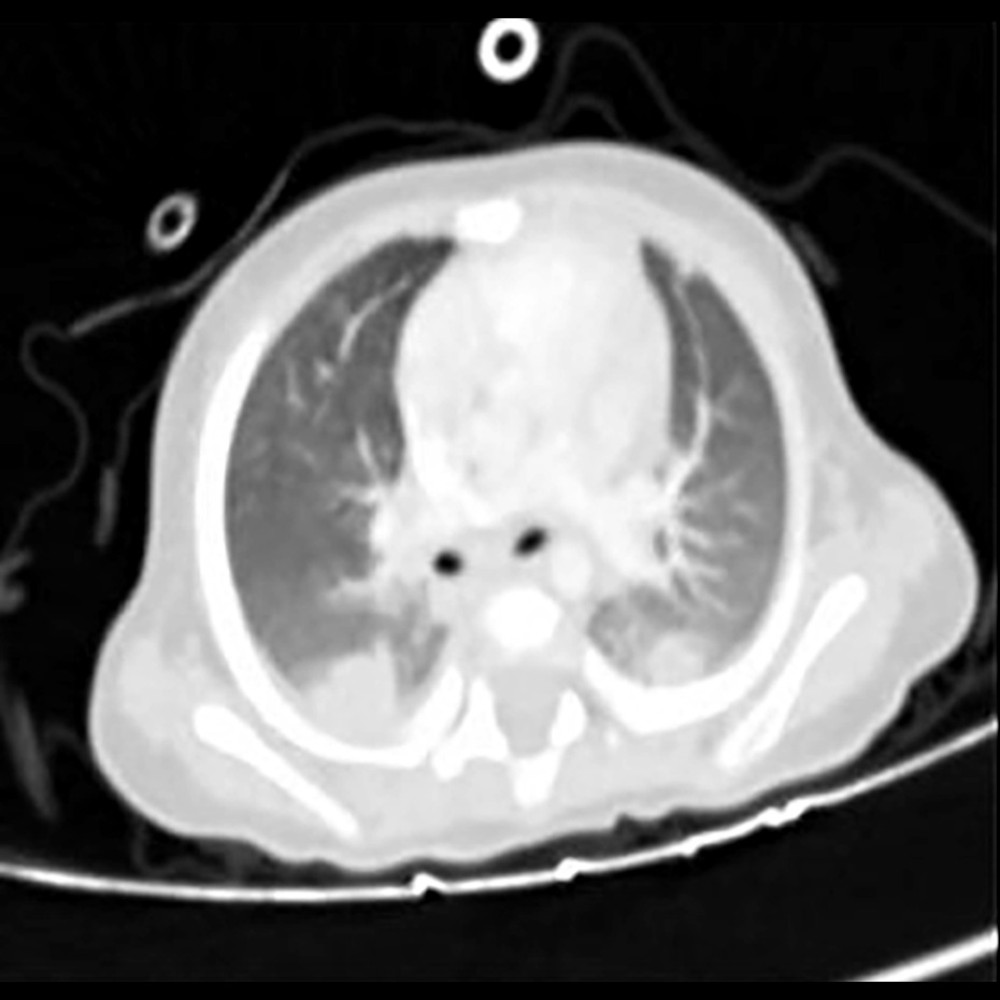 Lung computed tomography shows multiple metastatic lung nodules.