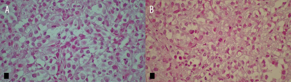 Hematoxylin and Eosin (×60) histopathological examination of the lesion: (A) nests of tumor cells embedded in myxoid stroma; and (B) nests of tumor cells with rounded nuclei and eosinophilc cytoplasm and rhabdoid morphology.