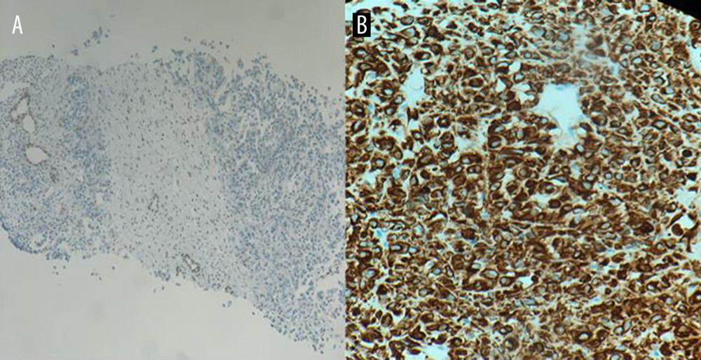 Immunohistochemical staining pattern of the lesion: (A) loss of integrase interactor 1 (1INI [BAF47]) nuclear staining; and (B) diffuse cytokeratin (CKAE1/AE3) immunostain positivity.