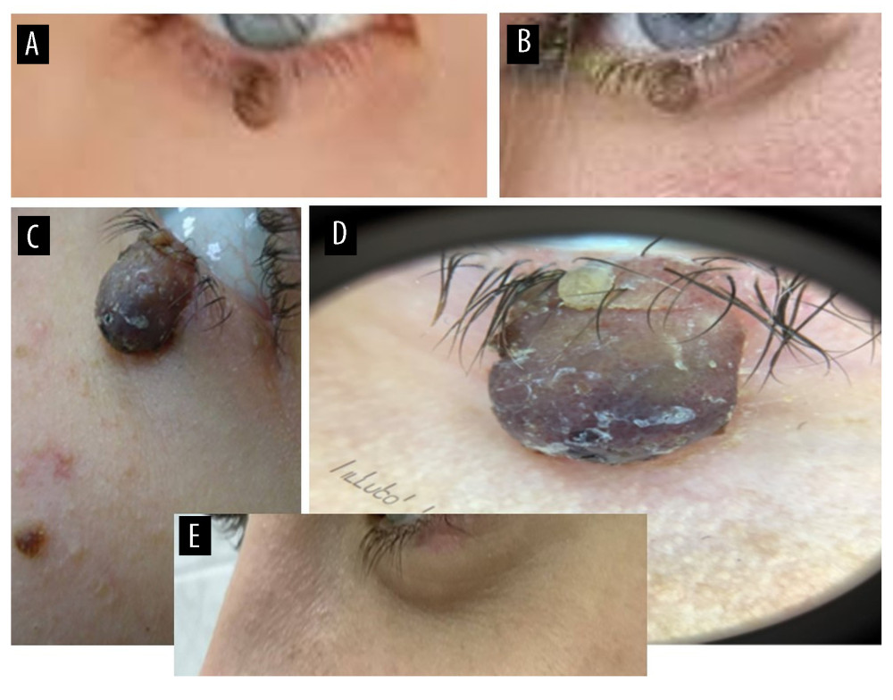 Photographs of the left lower eyelid poroma showing tumor growth over time and a result of surgical treatment. (A) tumor in 2007 (15 years old patient), (B) tumor in 2021, (C) tumor in 2022 – pretreatment clinical photograph, (D) clinical macro photograph, (E) photograph 10 days after tumor resection.