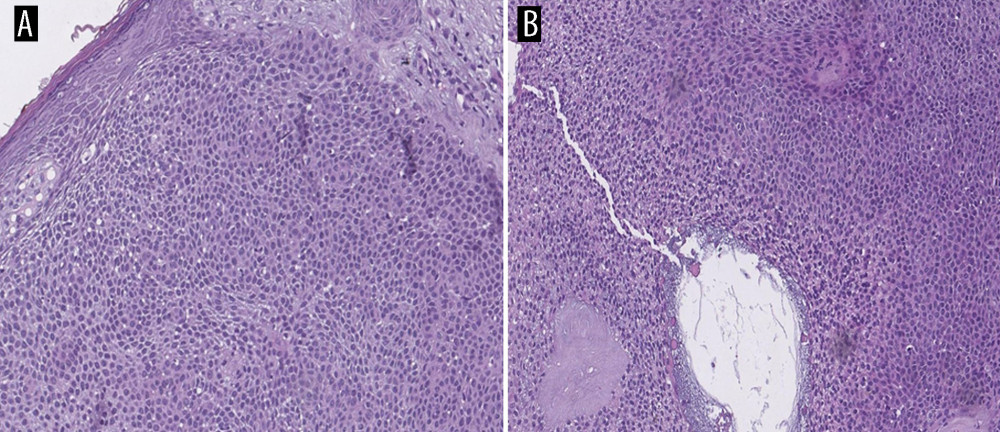 Hematoxylin and eosine (H&E) staining (A, B) demonstrates fragment of skin, covered by focally irritated epidermis with neutrophilic infiltration and features of hyper-/parakeratosis, spongiosis, hypergranulosis, irregular acanthosis with elongated rete ridges and proliferated basaloid cells with further spreading into reticular derma. Among this cell population, small cuboidal cells with a slightly increased cytoplasm and ovoid hyperchromatic nuclei are identified. The cells are arranged in groups with the formation of acanthotic-like cords with anastomoses and ductal-like structures. Some keratinocytes show the phenomena of intracytoplasmic accumulation of melanin, which contributes to the general pigmented appearance of the formation. The underlying derma is composed of proliferating blood vessels of capillary size with perivascular lymphocytic infiltration, interstitial edema, and myxoid response in the background (H&E ×40).