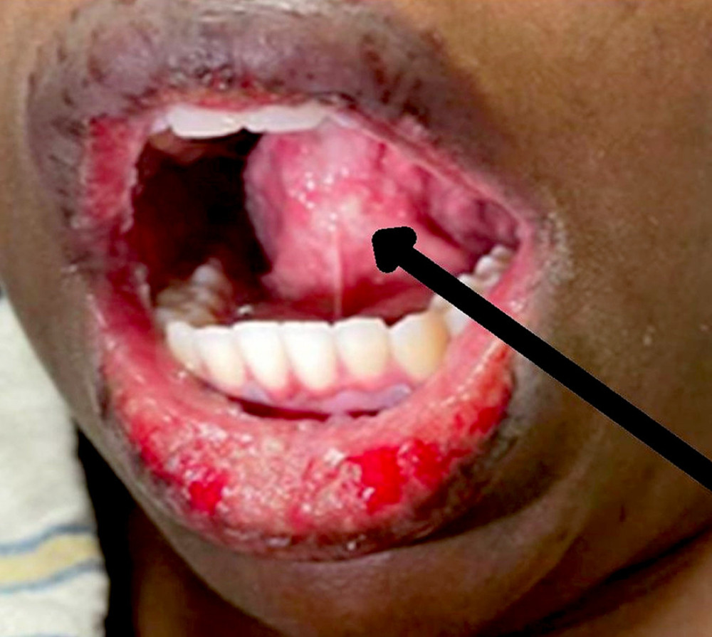 Within 24 h after application of the ophthalmic ofloxacin drops, blistering beneath the tongue at the black arrow further illustrates the classical and extensive mucocutaneous involvement seen in Stevens-Johnson syndrome.