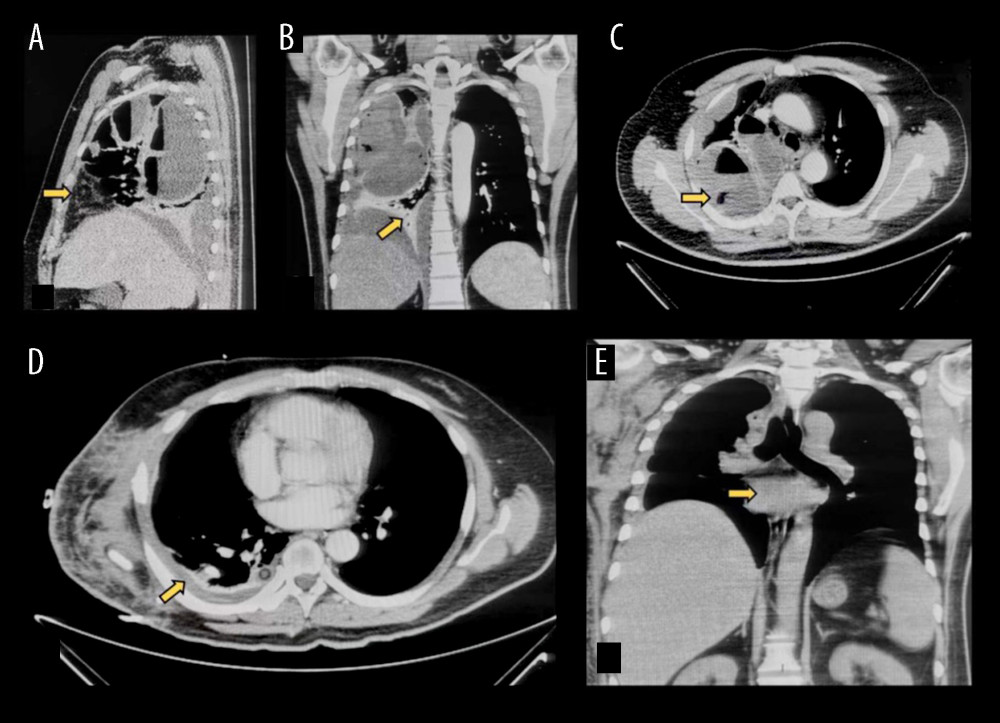 Comparison of chest computed tomography (CT) before and after the patient’s treatment. (A–C) Chest CT of the patient in the Emergency Department. (D, E) Chest CT examination before patient’s discharge. The yellow arrow points to the abscess.
