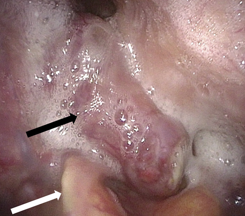 Endoscopy shows a right hypopharyngeal tumor (black arrow) occupying the glottis (white arrow).