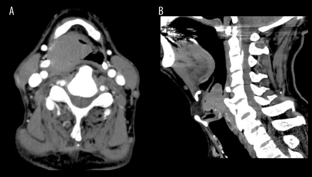 Computed tomography shows a 40-mm mass located at the hypopharynx and compressing the airway. (A) Axial; (B) sagittal.