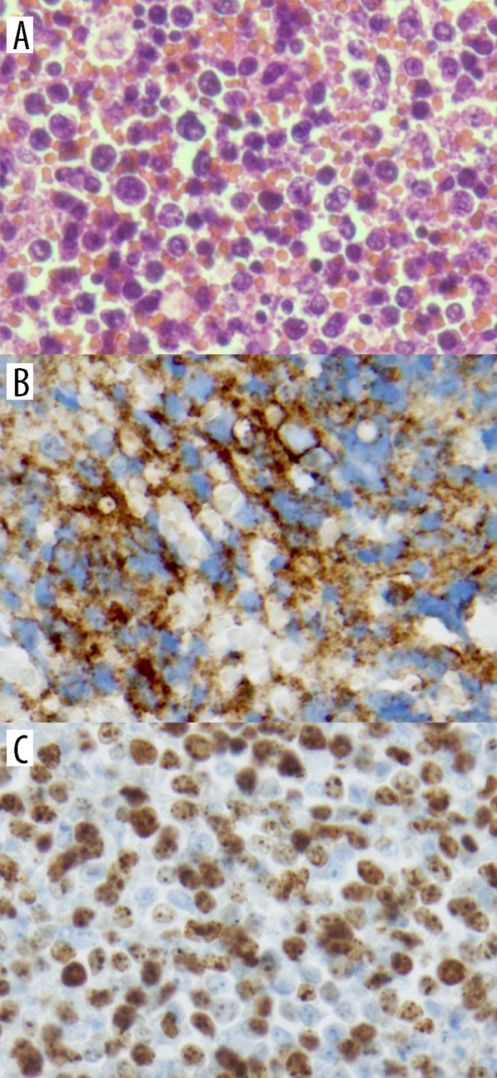 (A) Diffuse proliferation of large tumor cells (hematoxylin and eosin stain 400×), (B) CD-20 positive (400×), (C) Ki67 proliferation index (400×).