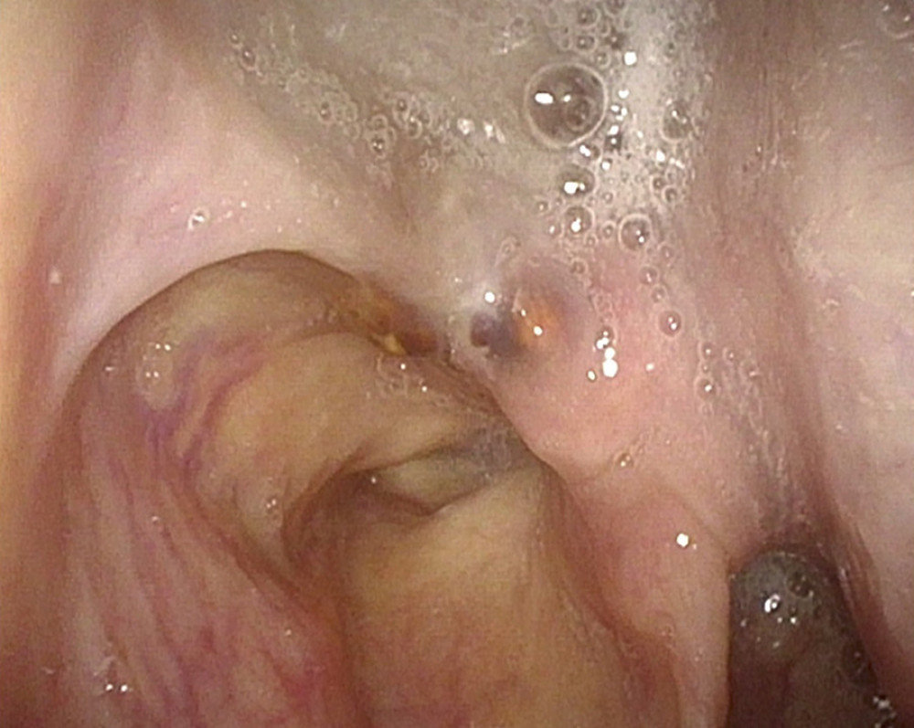Endoscopy shows disappearance of the tumor.