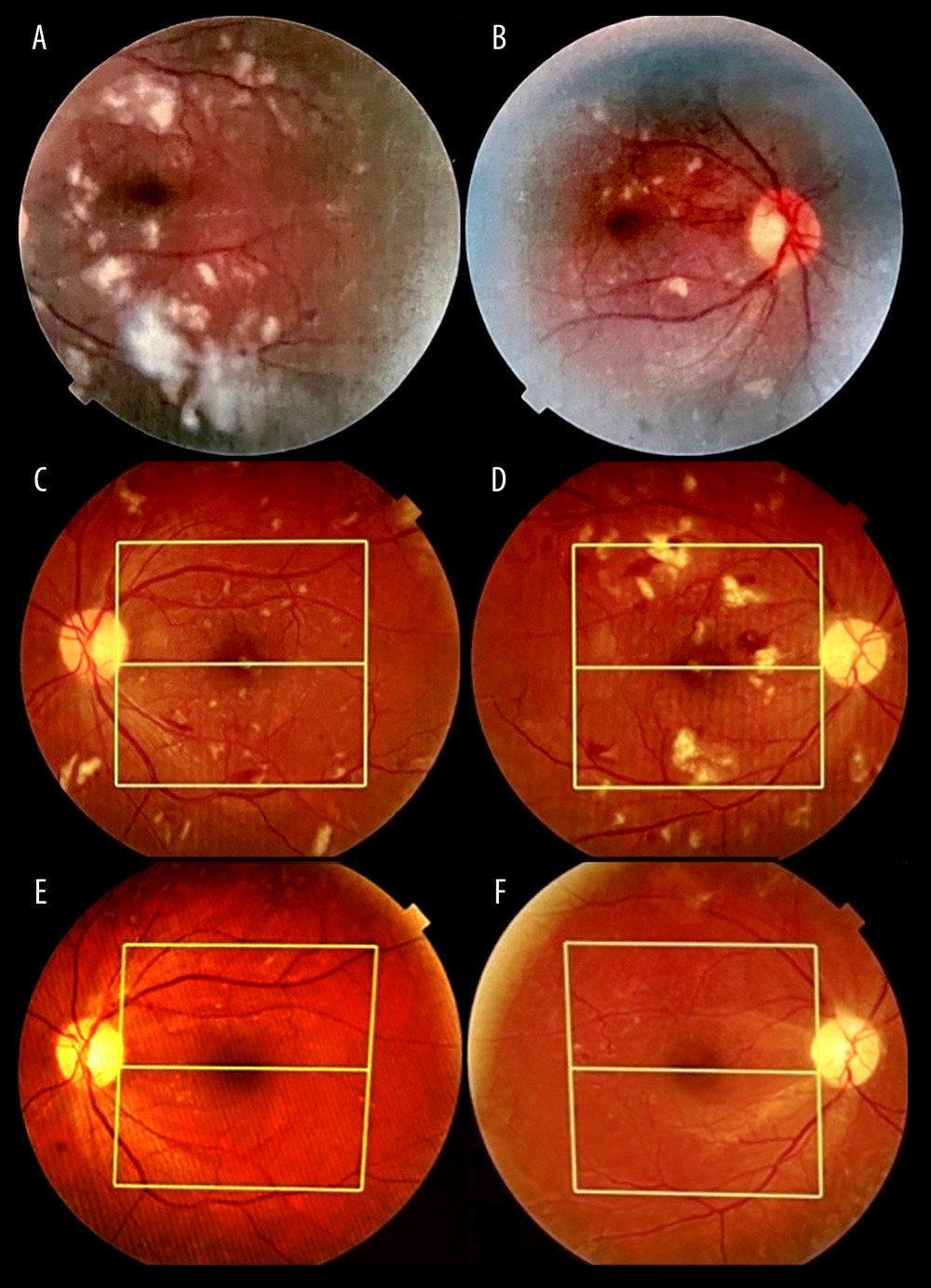 The color fundus photographs of the left (A) and right (B) eyes, showing bilateral diffuse multiple cotton-wool spots, dot and blot hemorrhage covering the posterior pole with venous congestion, and beading and cystoid macular edema (CME) in the fovea of both eyes. The left (C) and right (D) eyes, showing the fundus after 2 months, with residual cotton-wool spots, dot and blot hemorrhage, and CME. The left (E) and right (F) eyes, showing the disappearance of cotton-wool spots, dot and blot hemorrhage, with pan-retinal photocoagulation (PRP) marks after 18 months.