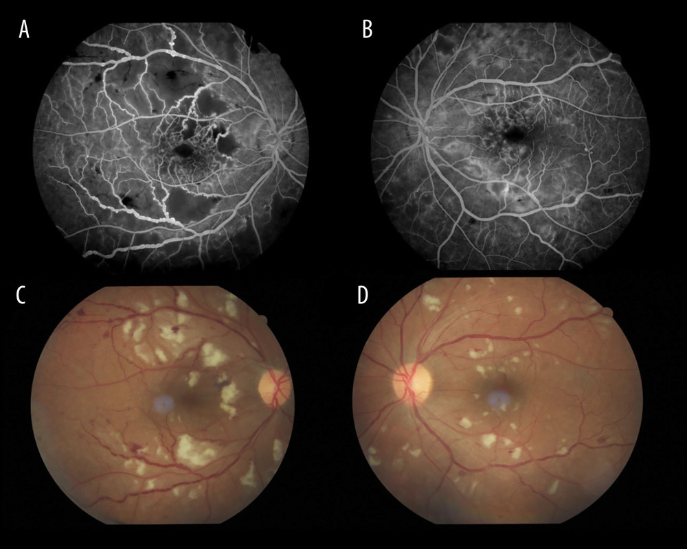 Fundus fluorescein angiography (FFA) of the right (A) and left (B) eyes done after 6 months, showing bilateral areas of peripheral and macular hypo-fluorescence, multiple hyper-fluorescent knob-like aneurysmal dilatations with vascular leaking and staining. The color fundus photographs of the right (C) and left (D) eyes at the same time of FFA, showing bilateral scattered cotton-wool spots, dot and blot hemorrhage, and CME. In addition, both (C) and (D) show bilateral scattered intraretinal microvascular abnormalities (IRMAs) with scattered collateral vessels.