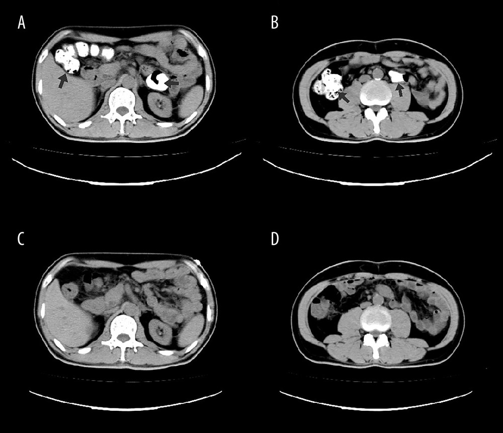 (A, B) Before treatment, abdominal computed tomography (CT) detected multiple hyperdensities in the large bowel. (C, D) After treatment, abdominal CT revealed the hyperdensities in the large bowel had almost disappeared.