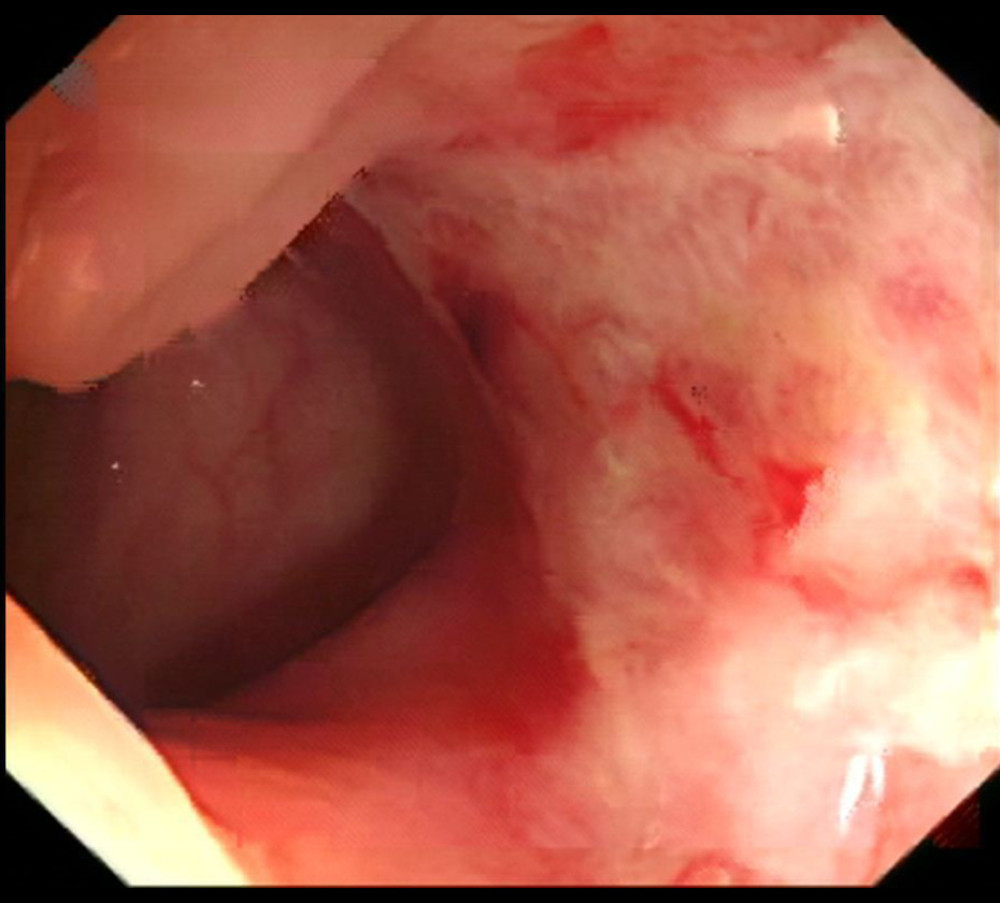 Colonoscopy showing a large ulceration on the large bowel mucosa, covered with a thin layer of white moss.