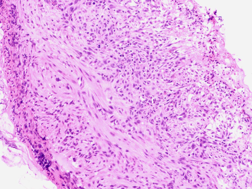 Large bowel biopsy specimen showing ulcerations, some inflammatory necrosis, and granulation tissue (Hematoxylin & Eosin: 400×).