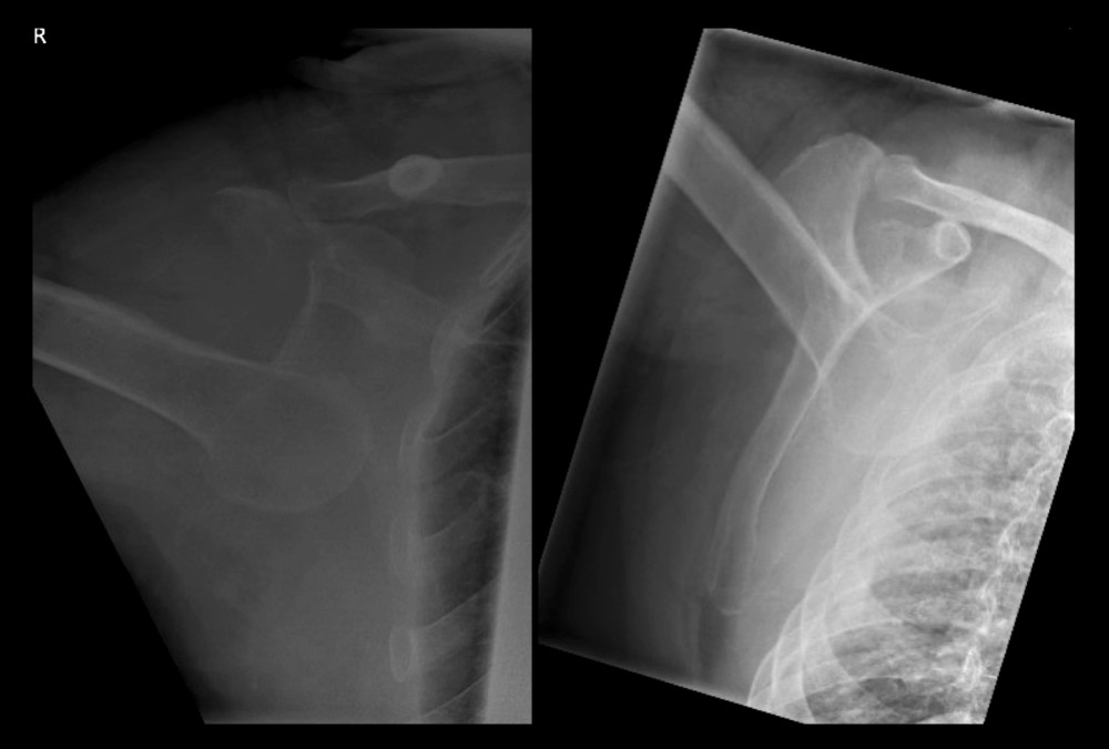 X-ray showing inferior shoulder dislocation and greater tuberosity fracture with anterior-posterior and lateral view.