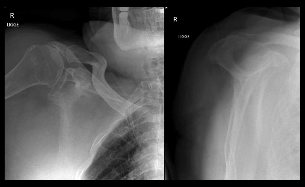 X-ray showing the glenohumeral joint after closed reduction with anterior-posterior and lateral view.