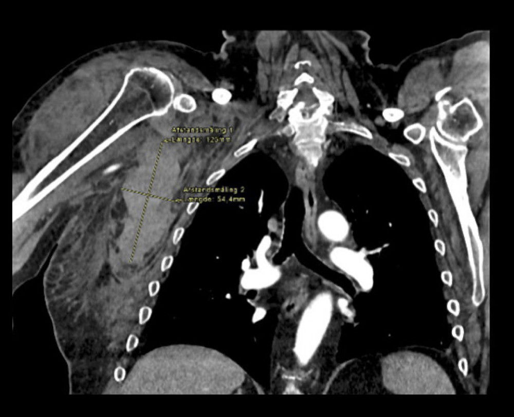 CT scan imaging a 12.5×6 centimeter large hematoma in the right axilla.