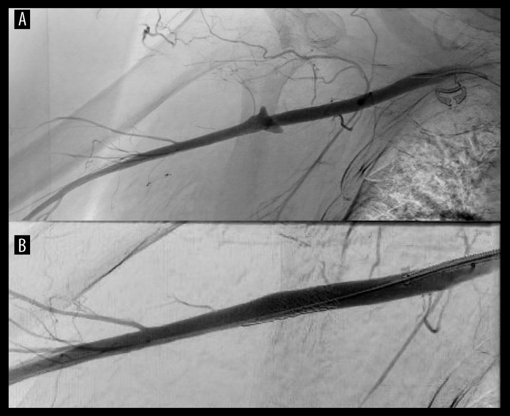 Arteriogram imaging axillary artery rupture with development of pseudoaneurysm (A) and termination of the pseudoaneurysm after stent placement (B).