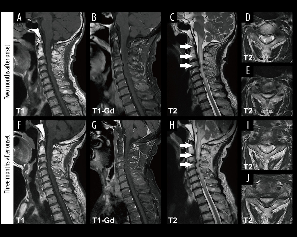 Cervical magnetic resonance imaging (MRI) before operation. (A–E) Two months after onset, C3–C7 disc herniation with cervical degeneration, posterior spondylolisthesis (degree I) with spinal stenosis, high-signal intensity area from medulla oblongata to T1 vertebral levels on T2-weighted MRI (arrows). No high-signal enhancement was found on T1-MRI with gadolinium. (F–J) Three months after onset, marked progression of T2-weighted high-signal area over the oblongata to T1 vertebral levels and has spread to the pons (arrows).