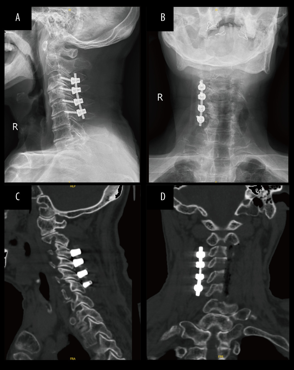 Postoperative cervical X-ray and computed tomography scans after the operation. Posterior C3–C6 expansive open-door cervical laminoplasty with lateral mass screw insertion and C2 and C7 decompression surgeries were performed. (A, B) X-ray scans 5 days after operation. (C, D) Computed tomography scans 5 days after the operation.